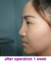 plastic_surgery_augmentation_rhinoplasty